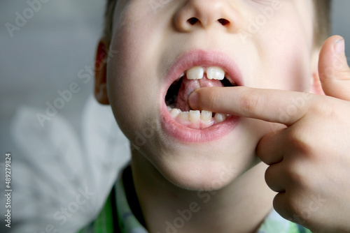 oral cavity of small patient, length of frenum of the tongue, boy, kid performs articulation exercises for mouth, concept of speech disorders, correction photo