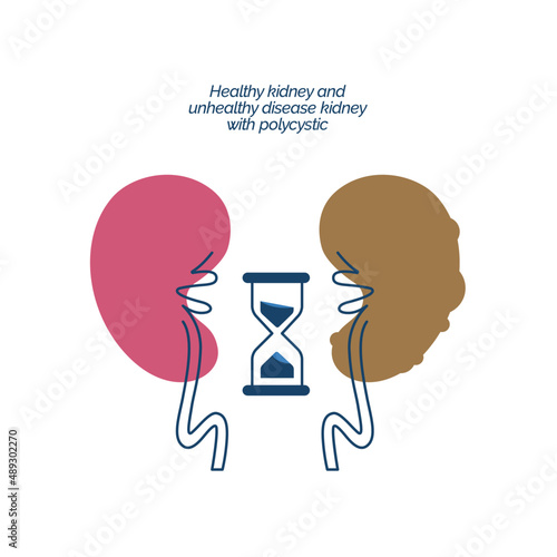 Healthy kidney and unhealthy disease kidney with polycystic. Check health of renal organ. Vector illustration
