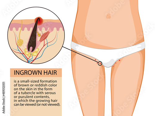 Ingrown hair. Informational training illustration. Female thighs in white underpants and a diagram of an ingrown hair with text. Vector illustration isolated on a white background for design and web. photo