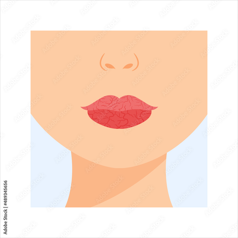 Beautiful Dry lips. Part of Female Face. Problem with Skin of Lips