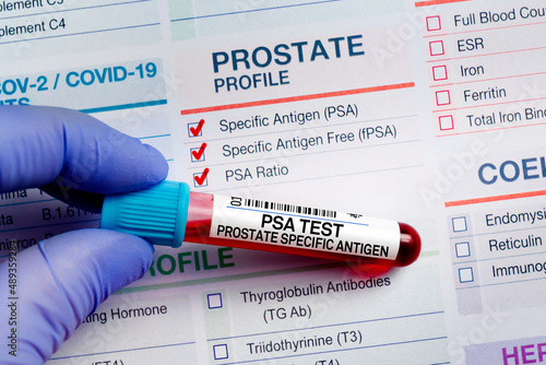 Blood tube test with requisition form for PSA Prostate Specific Antigen test. Blood sample tube for analysis of Prostate PSA profile test in laboratory photo