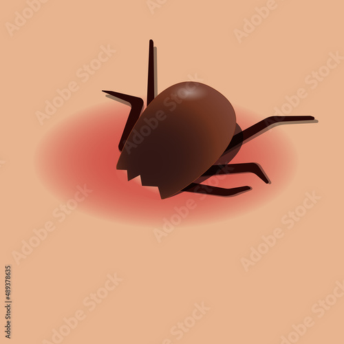 Tick biting through human skin