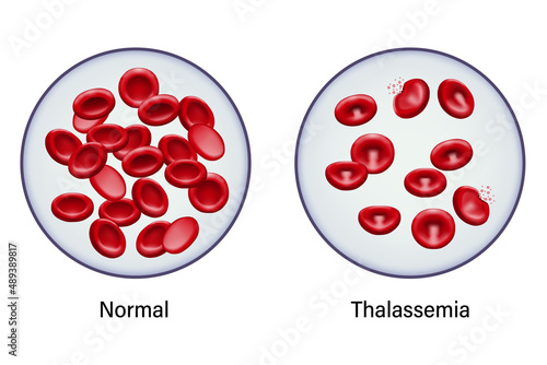 Diagram of comparison between normal red blood cells and thalassemia.