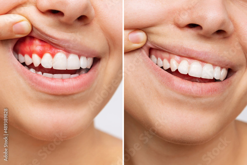 Two shots of a young woman with red bleeding gums and health gums  before and after treatment on a white background. Result of curing of gum inflammation. Close up. Dentistry  dental care