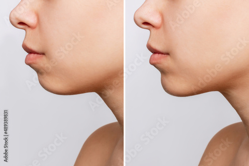 Сhin reduction. Cropped shot of woman's face with chin before and after mentoplasty isolated on a gray background. The result of cosmetic plastic surgery. Profile. Beauty concept photo