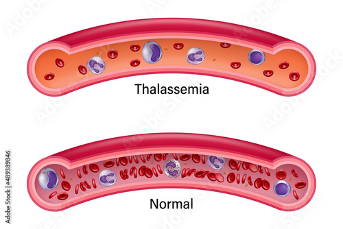 Comparison between normal red blood cells and thalassemia. Medical education.