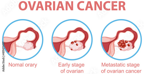 Ovarian cancer development process infographic