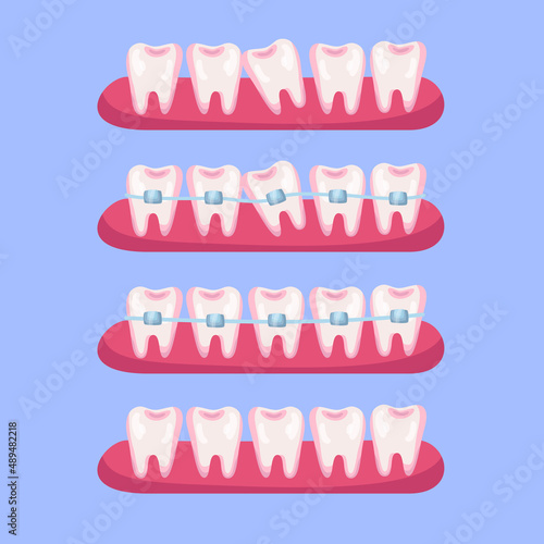 Teeth before and after braces cartoon illustration set. Stages of dental alignment or treatment with usage of brackets for beautiful smile. Orthodontist, healthcare, medicine concept