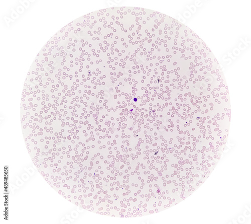 Hereditary hemolytic anemia. Hemoglobin E (HbE) disease, hypochromia with anisopoikilocytosis, pencil cell, target cell, tear drop cell present. Zoom Micrograph photo