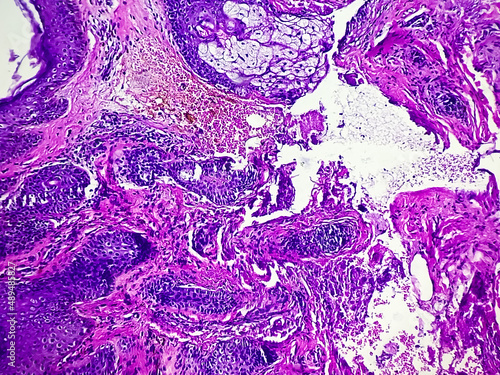 Tissue from ulcerated face lesion (biopsy) microscopic show  Basal cell carcinoma. Zoom image photo