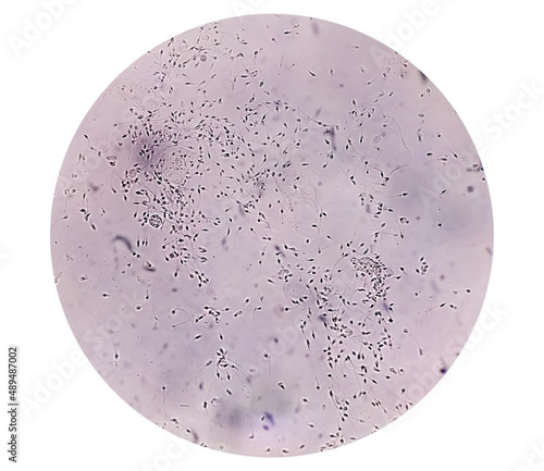 Polyzoospermia analyzed by microscope. Semen analysis normal sperm and morphology. Zoom image photo