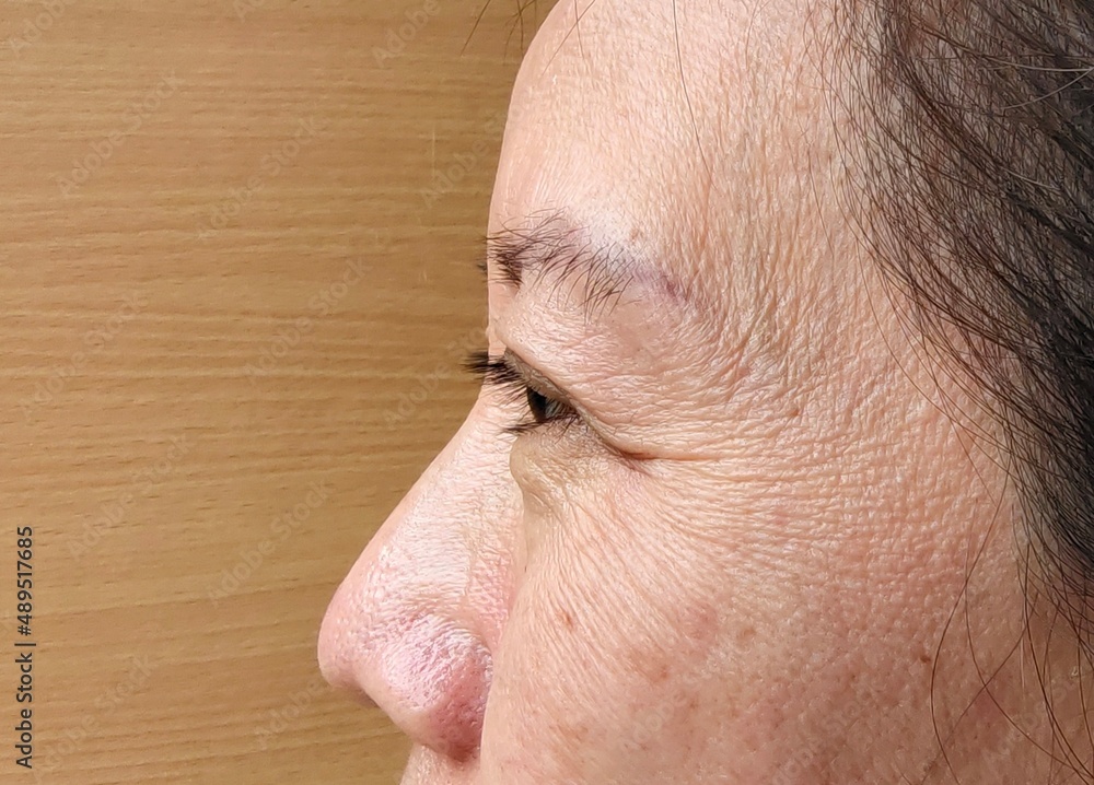 Obraz premium Portrait showing flabbiness skin beside on the face, problem double layered skin and ptosis on the eyelid of the woman, concept health care.