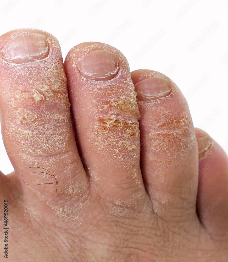 Fototapeta premium close-up of a man's toes with fungal disease, skin cracking and callus formation on his toes,