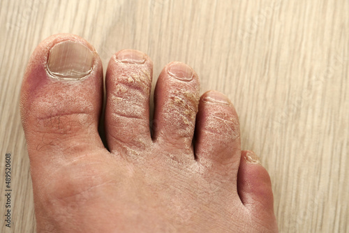 close-up callus formation on the toes of a man, dead skin on the fingers, photo