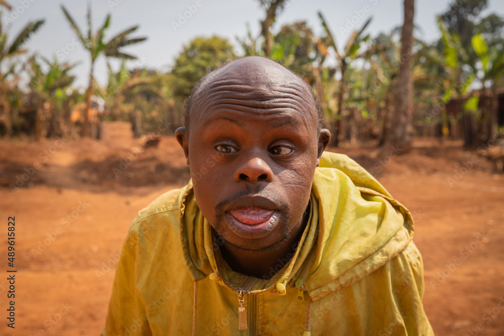 Portrait of an adult bald African man with Down syndrome, on a forest  background Stock Photo | Adobe Stock