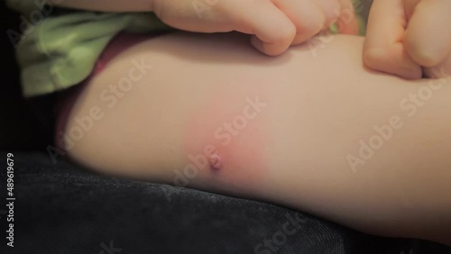  infected molluscum contagiosum swelling, redness leg of a three-year-old child photo