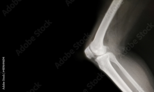 knee bone computer x-ray images