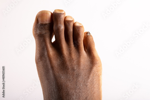 pointy african feet with onychomycosis photo