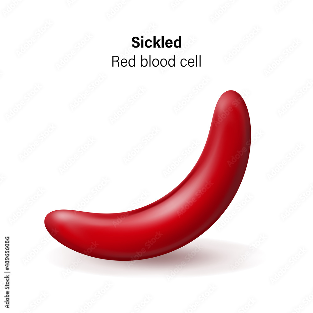 Sickle Cell Disease Sickled Red Blood Cells Vector Stock Vector sickle-cell-disease-sickled-red-blood-cells-vector-stock-vector