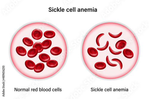 Sickle cell disease. The difference of Normal red blood cell and sickle cell. photo