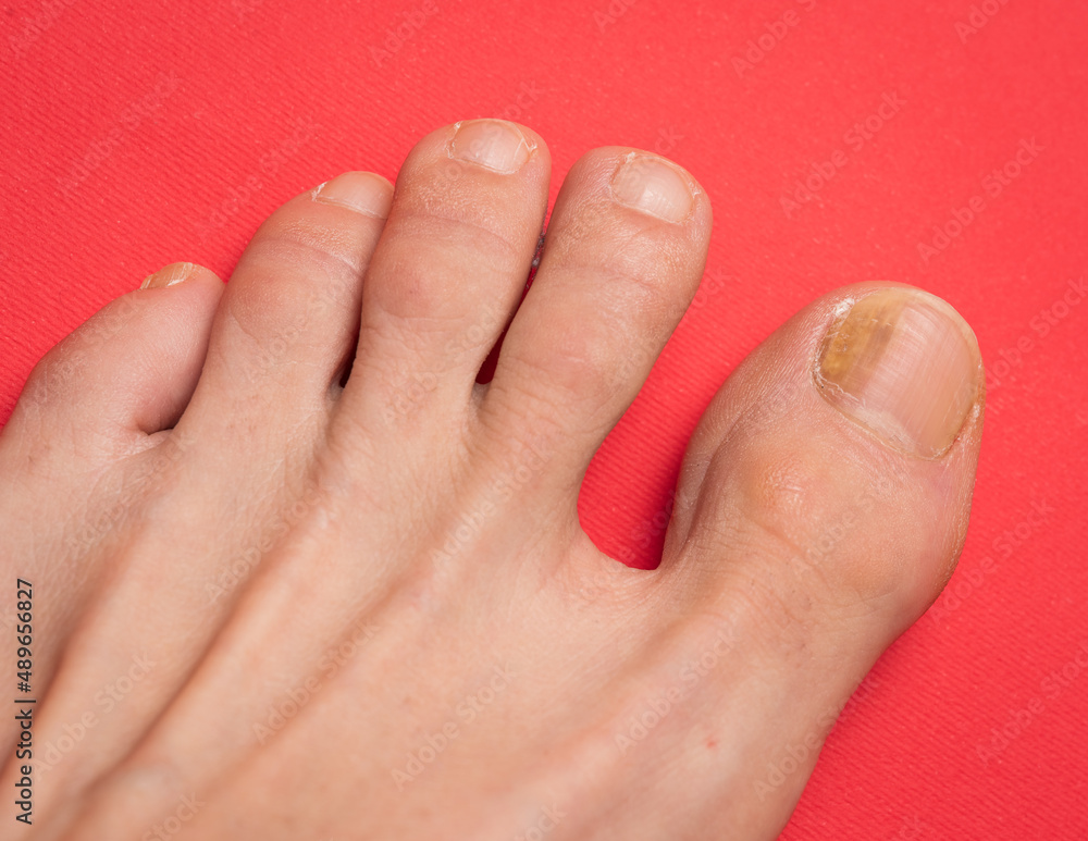 Toenails with fungus problems,Onychomycosis, also known as tinea unguium, is a fungal infection of the nail, red background. Toenails with fungus problems,Onychomycosis, also known as tinea unguium, is a fungal infection of the nail, red background.