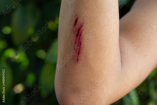 Wounds on the arm of a men due to an accident from fall.
