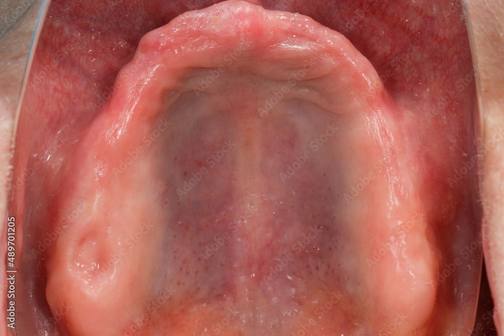 Fototapeta premium edentulous upper jaw with perfect gingiva before implantation, seen through a mirror