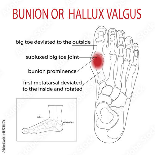 Bursitis on the sides of the foot. The bone and skin on the sides of the big toe joint form an abnormal foot shape. Common problem