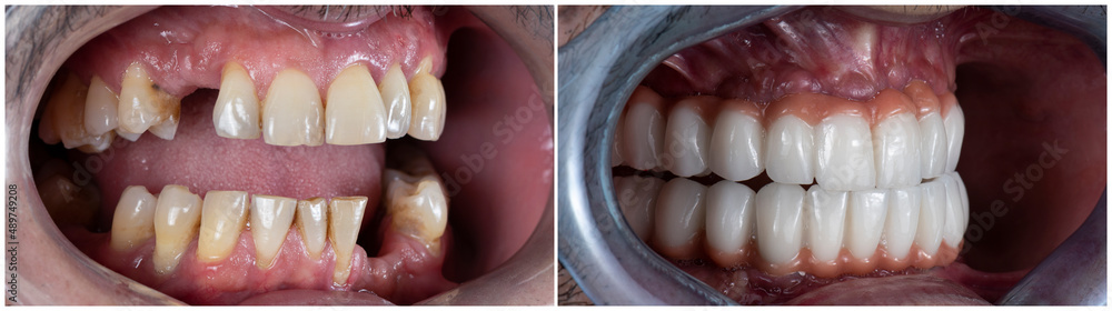 Obraz premium press ceramic crowns on implant bridges