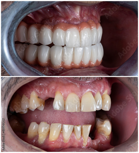 press ceramic crowns on implant bridges