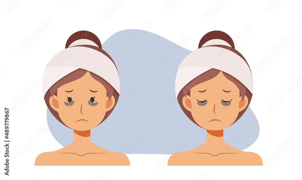 Skin care,beauty concept illustration. woman with dark circles on face. woman worried about dark circles.Flat vector cartoon character illustration. Skin care,beauty concept illustration. woman with dark circles on face. woman worried about dark circles.Flat vector cartoon character illustration.