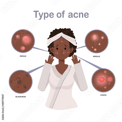 Acne Types.African american woman With Acne On Face, Facial, Beauty, Cosmetic, Makeup, Treatment, Healthy. Flat vector cartoon character illustration.