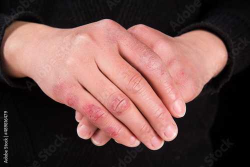 close up of female hand with chilblain on black background photo