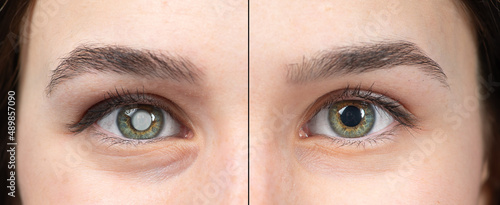 Macro of the eye of a young woman with and without cataracts