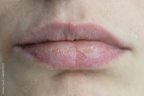 Closeup caucasian woman face with brittle and dry chapped lips, soft focus. Peeling, coarsening, discomfort and cold season. Beauty dermatology, skin sensitivity concept.  photo