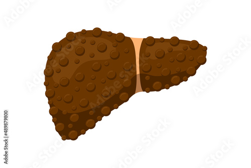 Sick unhealthy liver with cirrhosis or hepatitis. Damaged human exocrine gland internal organ destruction concept. Vector fatty hepatic eps isolated illustration