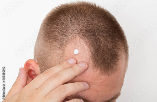 Healing cream for the restoration of damaged hair on a receding hairline on a man's head. Hair follicle restoration, close-up
