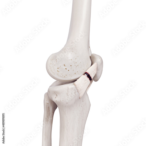 3d rendered medically accurate illustration of a torn medial patellar ligament photo