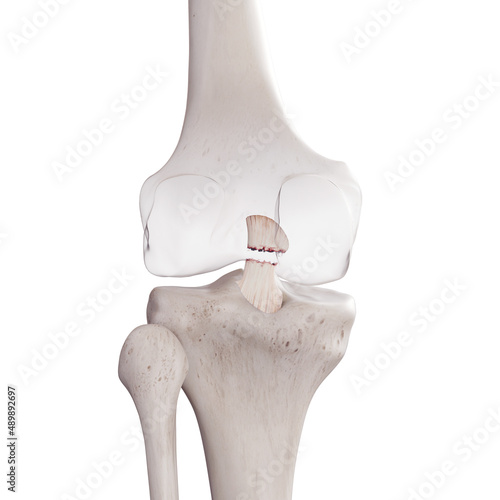 3d rendered medically accurate illustration of a torn posterior cruciate ligament photo