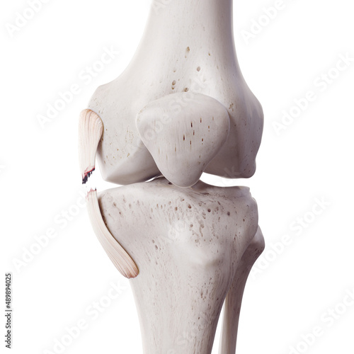 3d rendered medically accurate illustration of a torn tibial collateral ligament photo