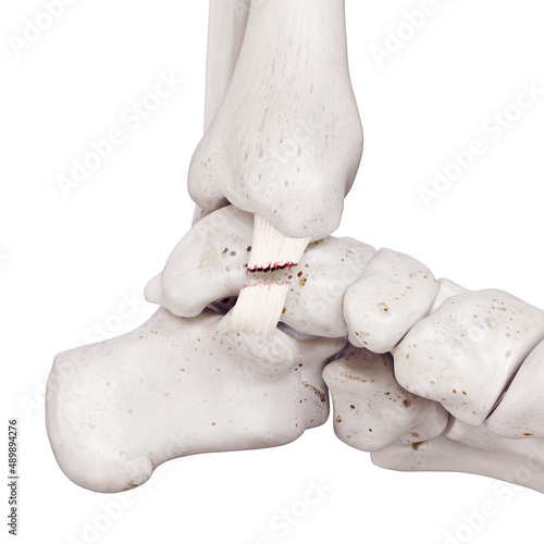 3d rendered medically accurate illustration of a torn tibiocalcaneal ligament photo