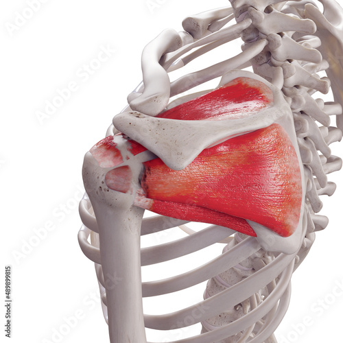 3d rendered medically accurate illustration of a torn rotator cuff