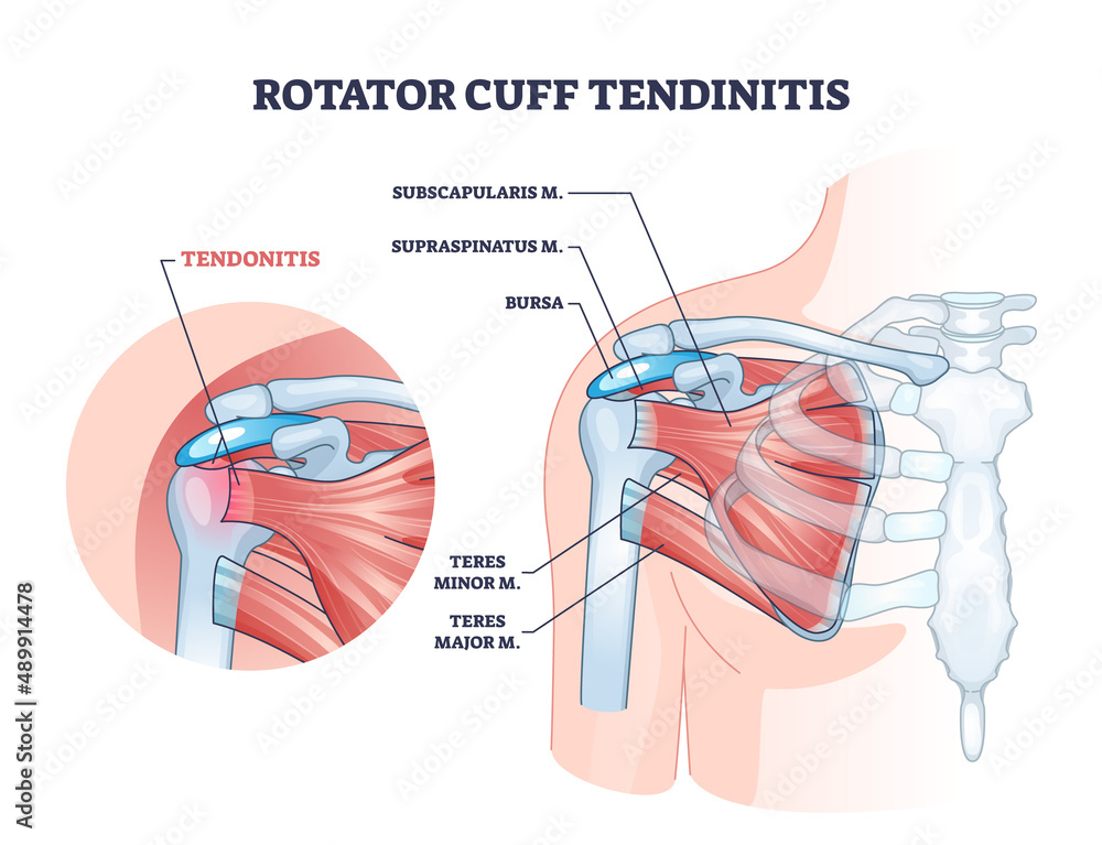 Rotator cuff tendinitis as shoulder muscular inflammation outline