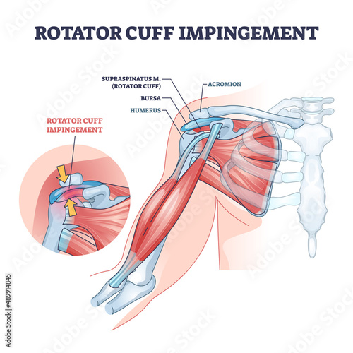 Rotator cuff impingement and anatomical shoulder muscle outline diagram. Labeled educational muscular and skeletal description with injury example vector illustration. Supraspinatus body part location photo