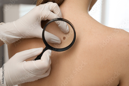 Dermatologist examining patient's birthmark with magnifying glass in clinic, closeup view