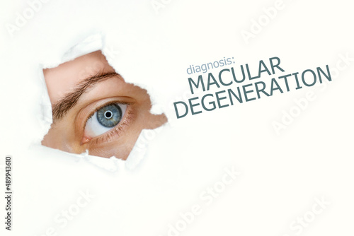 Macular degeneration disease poster with eye test chart and blue eye.Isolated on white