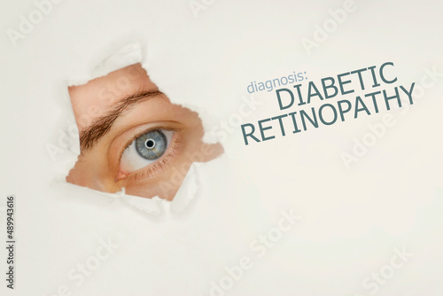 Diabetic retinopathy disease poster with eye test chart and blue eye.Studio grey background photo