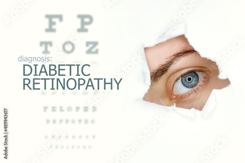 Diabetic retinopathy disease poster with eye test chart and blue eye.Isolated on white photo