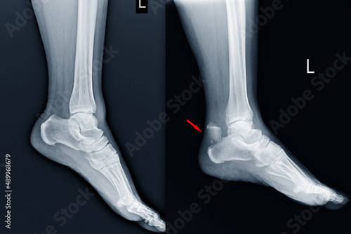 Film ankle X-ray radiograph showing heel bone narmal and broken on red point (close fracture calcaneus) . Medical technology and healthcare concept. photo