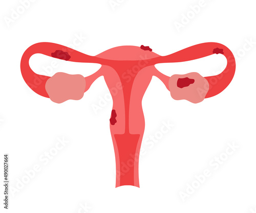Endometriosis gynecological health disorder, overgrowth of endometrium. Risk of cancer and infertility woman. Vector illustration